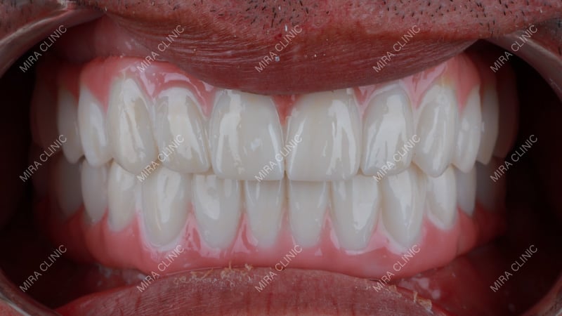Full Set of Dental Crowns